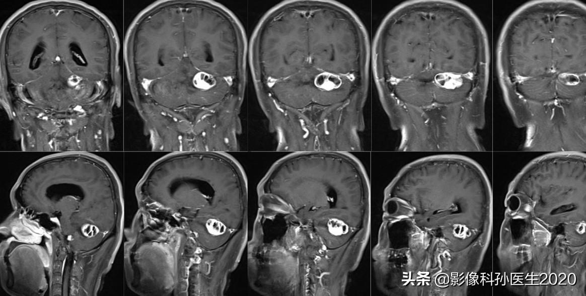 髓母细胞瘤最新治疗进展探索